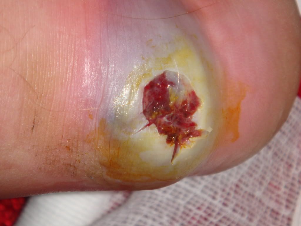 Worst Spider Bite
