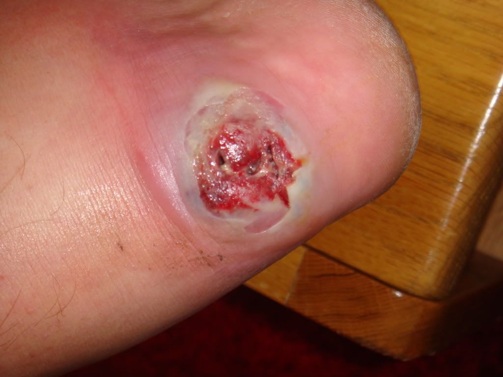 Worst Spider Bite